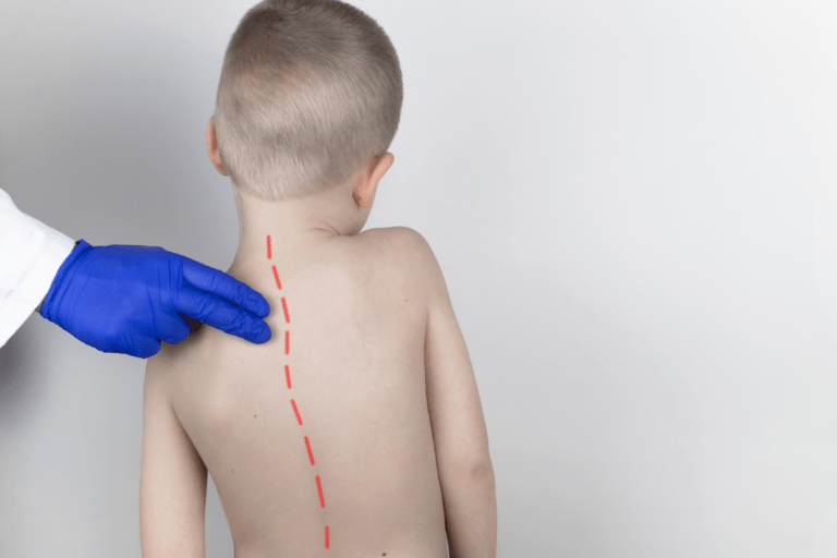 Scolioza la copii. Cauze, diagnosticare și tratament